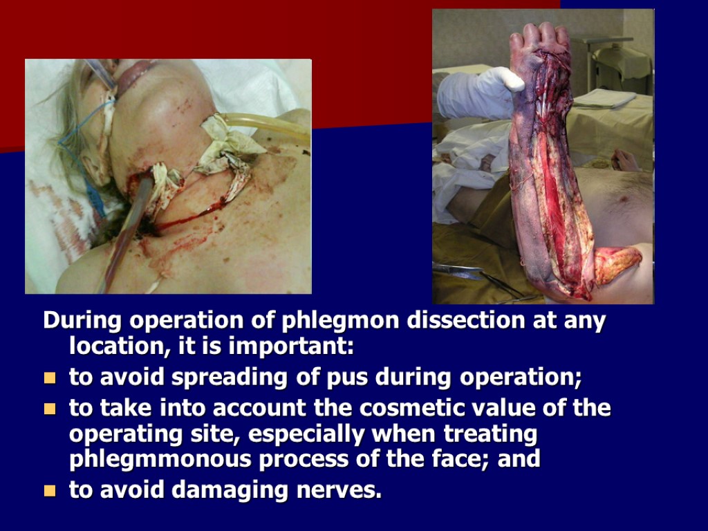 During operation of phlegmon dissection at any location, it is important: to avoid spreading
